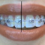 میدلاین دندان چیست و آیا تعیین میدلاین دندان اهمیت دارد؟