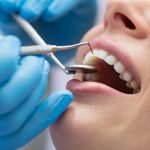 نکاتی برای حفاظت از دندان عصب کشی شده
