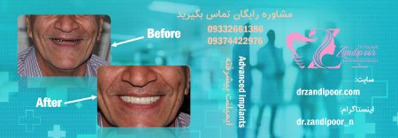 ایمپلنت دندان و جراحی زیبایی بینی، پلک و ابرو – دکتر نجمه زندی پور