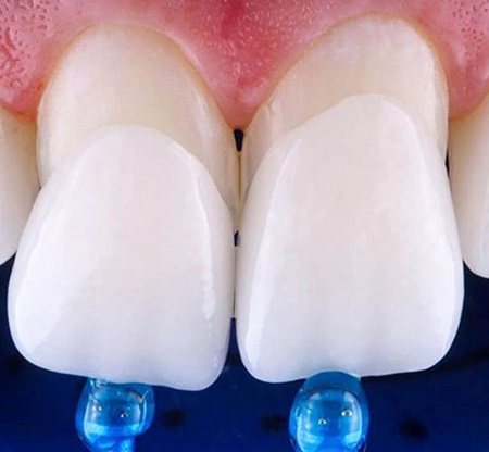 دندان های ترمیم شده با کامپوزیت ونیر , عوارض کامپوزیت ونیر , مزایای کامپوزیت ونیر  دندان