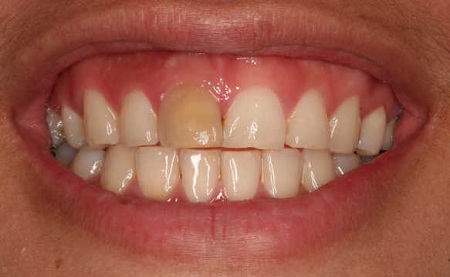 درمان سیاهی دندان با قطره آهن, مشکلات سیاهی دندان, از بین بردن سیاهی دندان