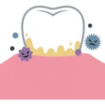 علل، عوارض و درمان تارتار دندان