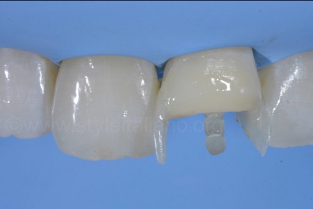 نحوه ساخته شدن فایبر پست دندان فایبر پست دندان , فایبر پست ها در بازسازی دندان , مراحل فایبر پست 