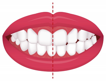 انحراف میدلاین دندان با ارتودنسی, ناهماهنگی خط وسط دندان, انواع میدلاین دندان