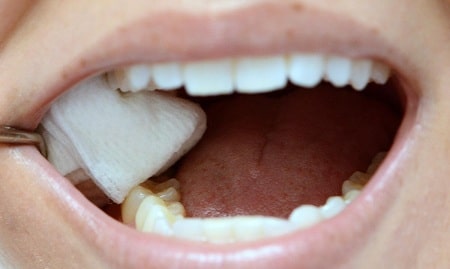 پانسمان موقت دندان چیست؟ زمان برداشتن و مراقبت از آن