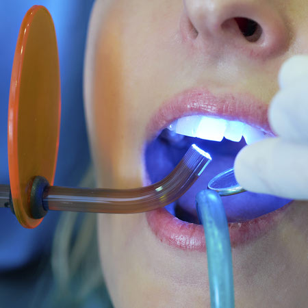 نحوه پر کردن دندان با کامپوزیت, بهترين مواد پركردن دندان, مزایای پرکردن دندان با کامپوزیت