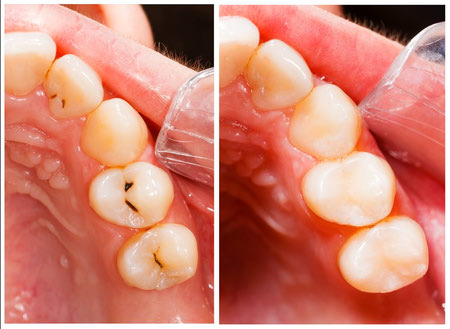 مراقبت بعد از پر كردن دندان با كامپوزيت, مراحل پر کردن دندان با کامپوزیت, معایب کامپوزیت دندان