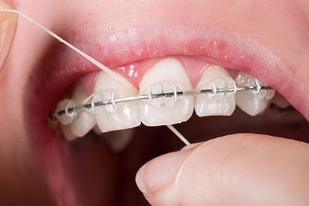 نخ دندان کشیدن حین ارتودنسی, طریقه نخ دندان کشیدن در ارتودنسی