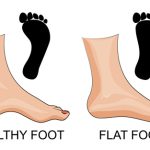 ۷ تمرین ارتوپدی برای افزایش قوس کف پا و کاهش درد پا